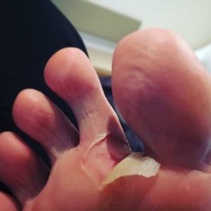 Foot problems on the Camino de Santiago Way of Saint James Hike